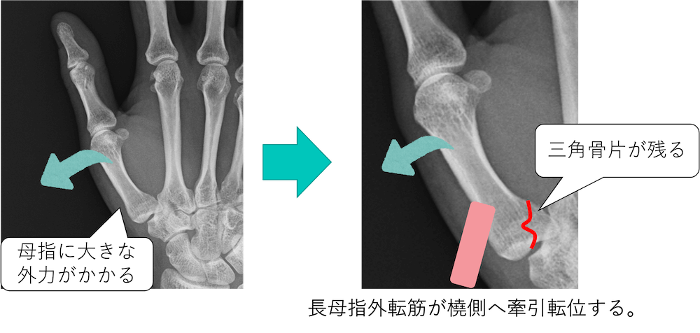 第1中手骨基部骨折(母指関節中手骨骨折)と画像所見のポイント